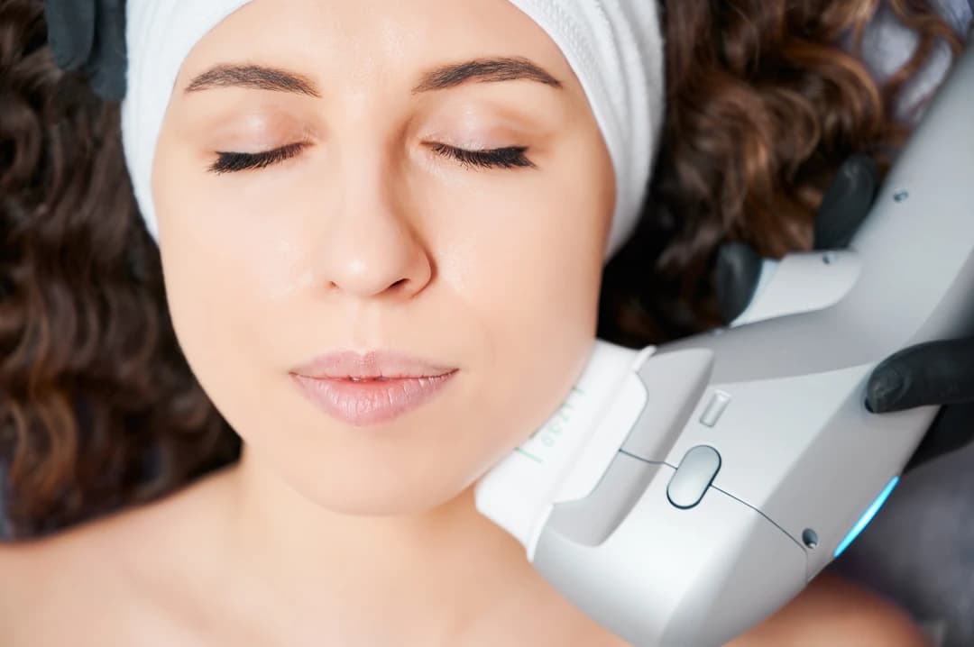 IPL Photofacial - Image 2