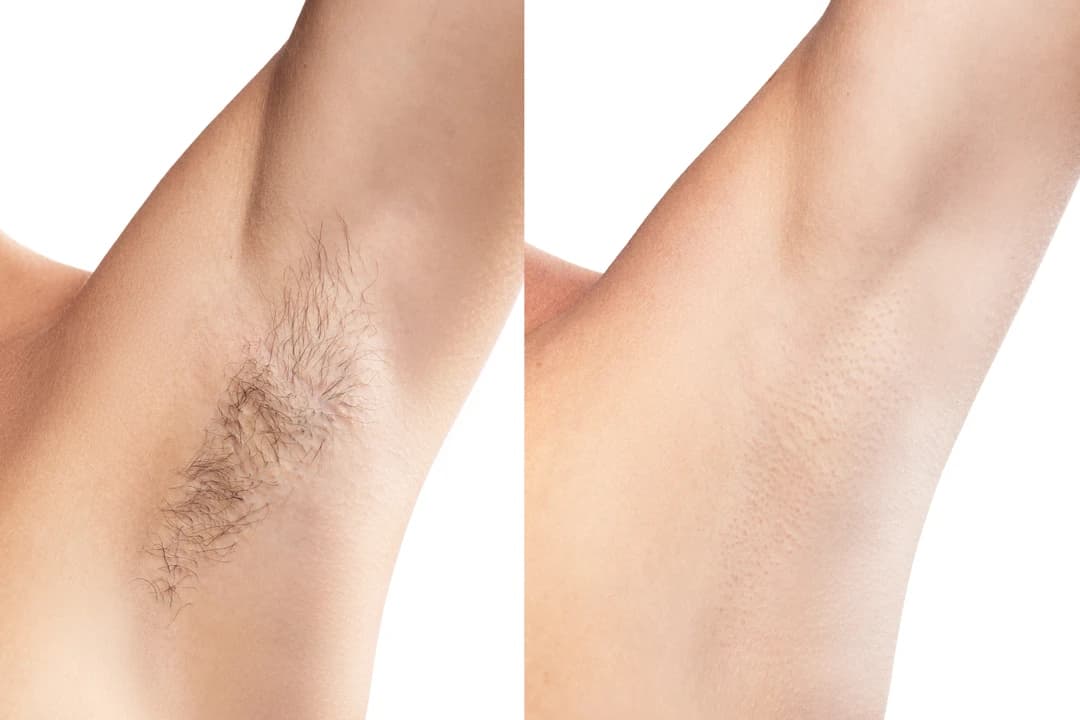 Laser Hair Removal Treatment - Image 5