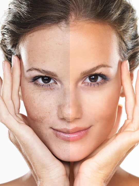 Laser Pigmentation Removal