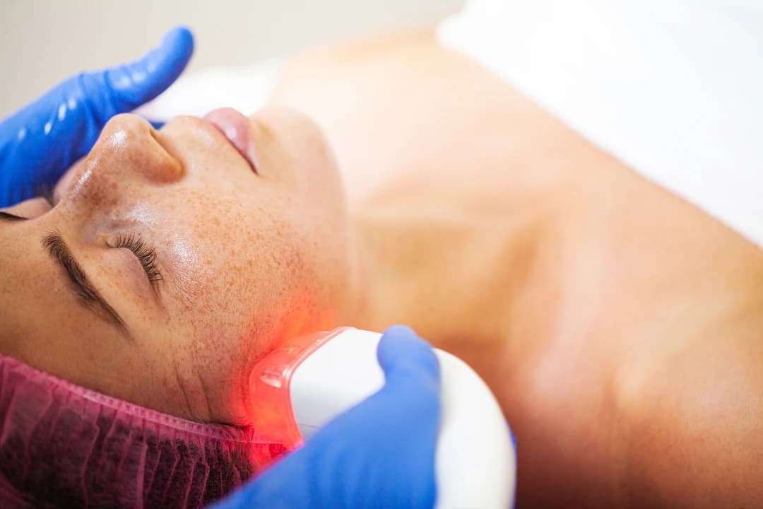 Laser Pigmentation Removal - Image 2