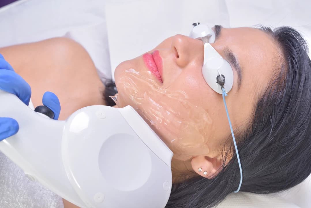 Laser Skin Tightening - Image 2