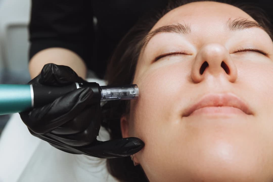 Microneedling - Image 2