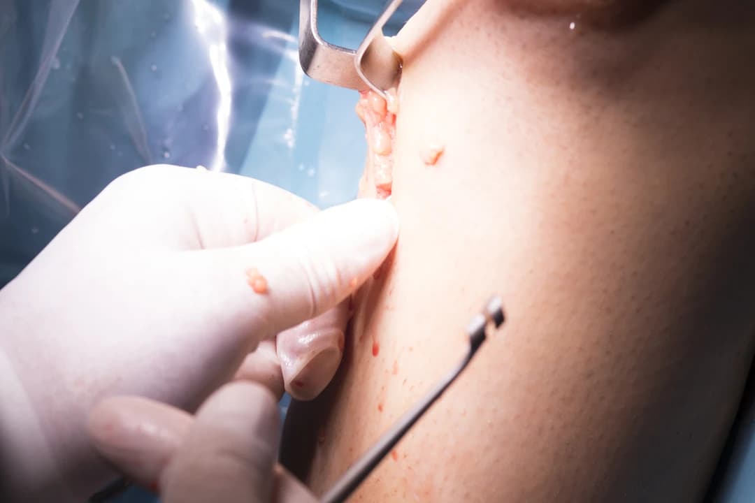 Skin Tag Removal - Image 2