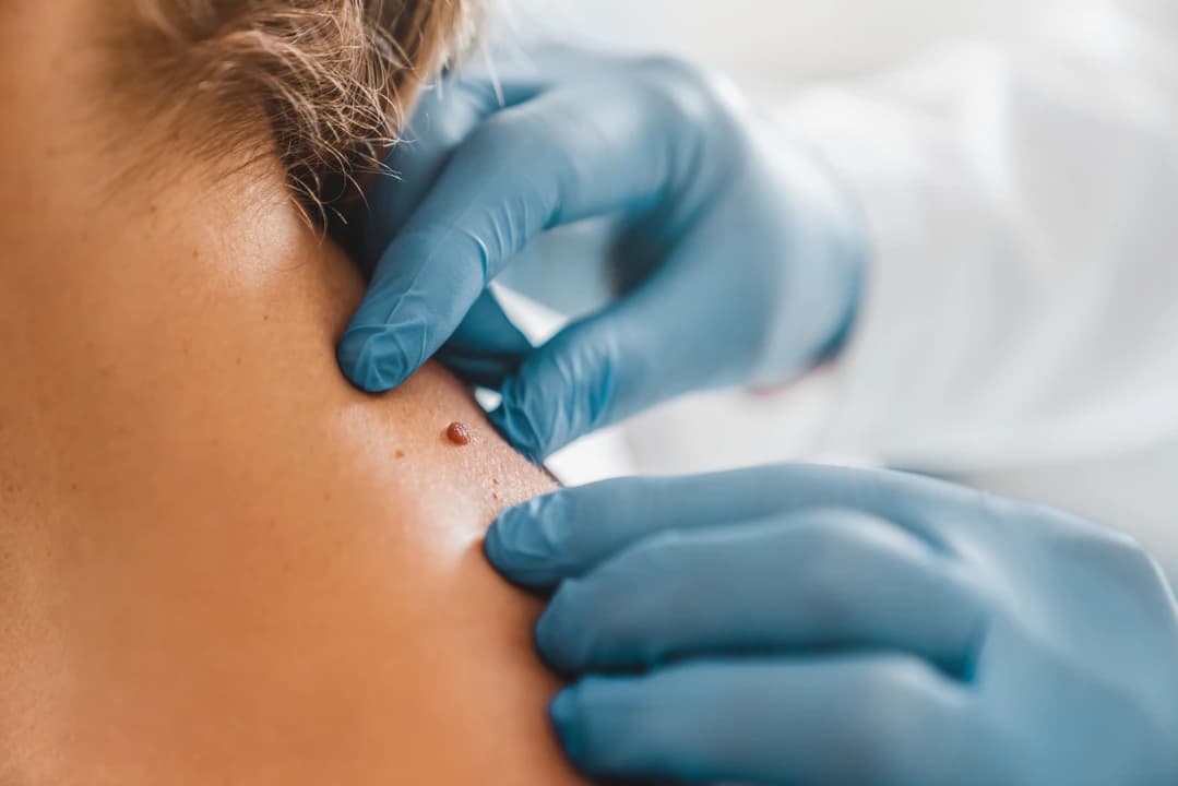Skin Tag Removal - Image 4