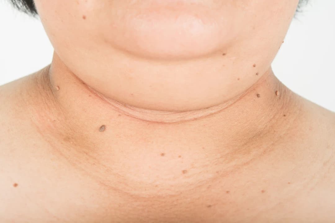 Skin Tag Removal - Image 5