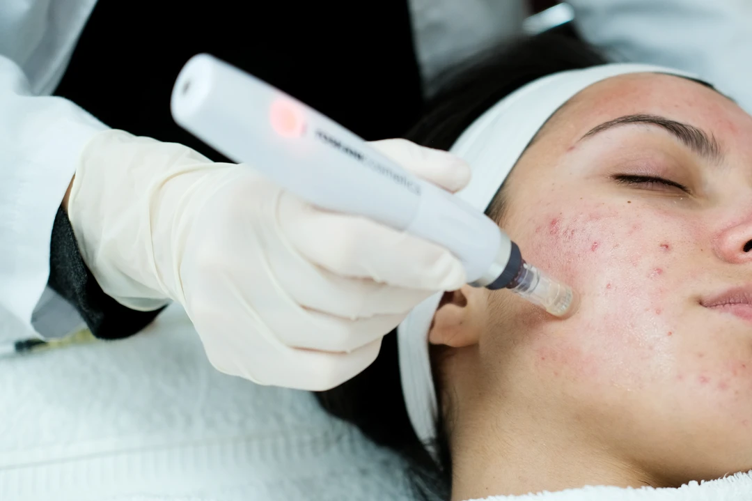 Microneedling in Calgary